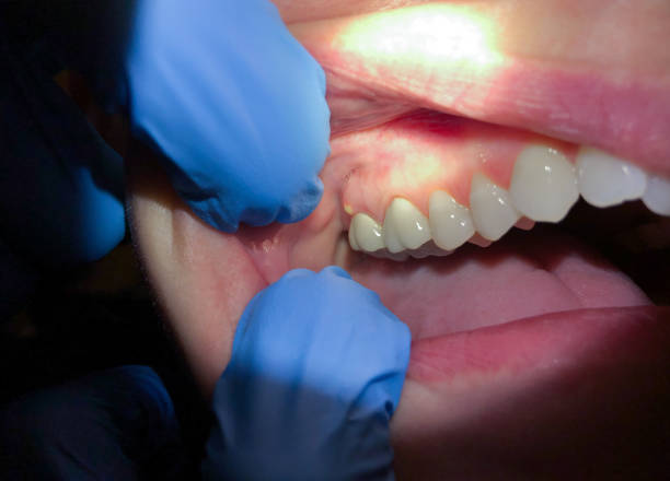 Best Emergency Denture Repair in Waterloo, IL