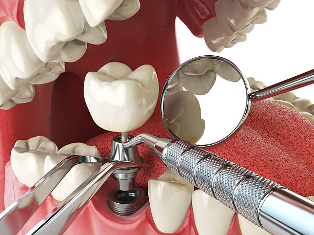 Best Emergency Treatment for Dental Infections or Abscesses in Waterloo, IL